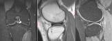 discoid meniscus